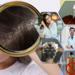 Dandruff and itchy scalp