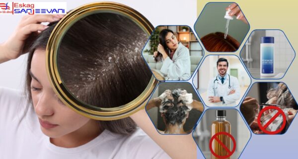 Dandruff and itchy scalp
