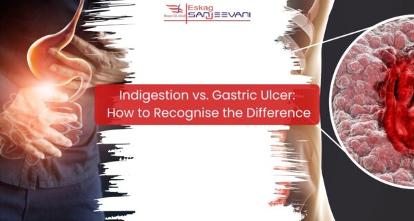 Indigestion vs ulcer