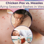 Chicken Pox vs. Measles