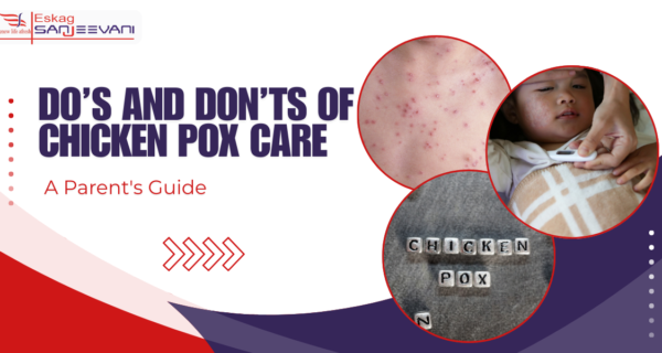 chicken pox care