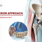Direct anterior approach