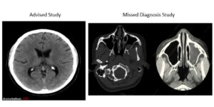 Brain pain that starts in the sinuses