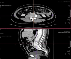Abdominal pain caused by a spinal problem
