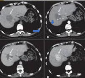 A liver lesion that needs contrast