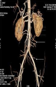 A liver lesion that needs contrast