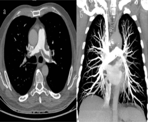 A hidden pulmonary embolism