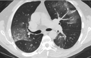 A hidden pulmonary embolism
