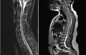 The spine problem behind walking difficulty