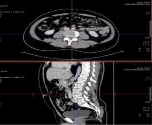 Abdominal pain caused by a spinal problem