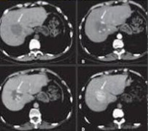 A liver lesion that needs contrast