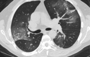 A hidden pulmonary embolism
