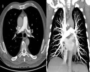 A hidden pulmonary embolism