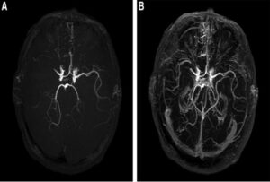 The hidden stroke in the brain vessels