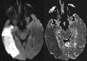 The hidden stroke in the brain vessels