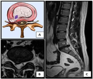 The spine problem behind walking difficulty