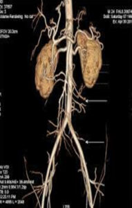 A liver lesion that needs contrast