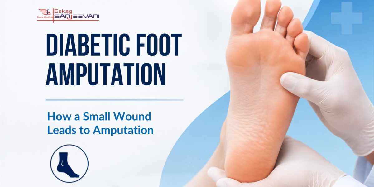Diabetic Foot Amputation