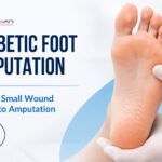 Diabetic Foot Amputation