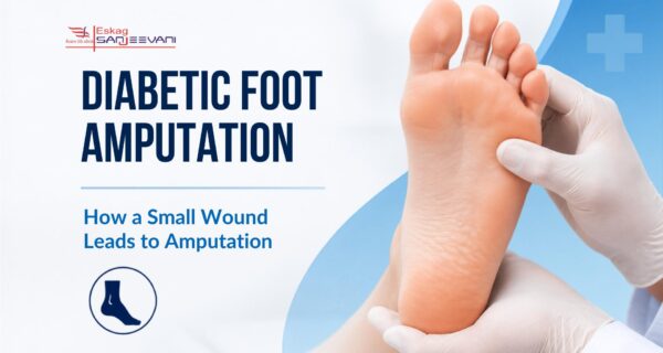 Diabetic Foot Amputation