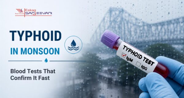 typhoid in monsoon